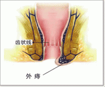 外痔百科