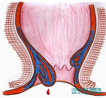 拉屎拉出血是怎么回事？