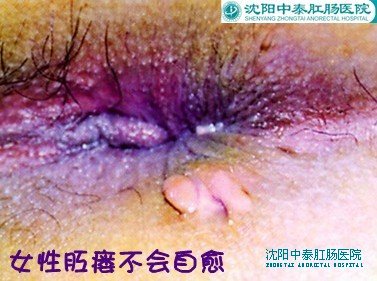 女性肛瘘不会自愈