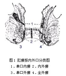 肛瘘