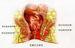 肛瘘